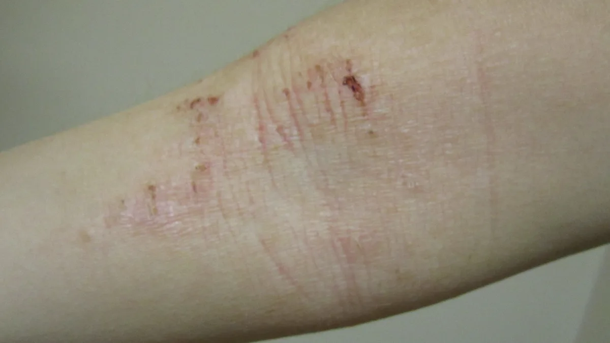 Atopic Dermatitis